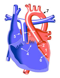 Double Inlet Left Ventricle Diagram
