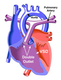 Double Outlet Right Ventricle Diagram