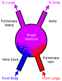 Single Ventricle Heart Defects Diagram